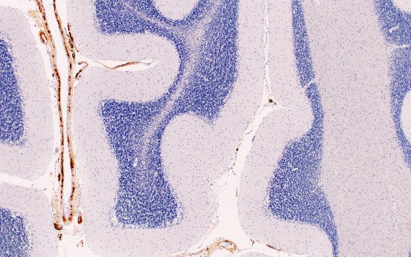 12C Small vessel Dz (Case 12) N9 H&E 4X 2