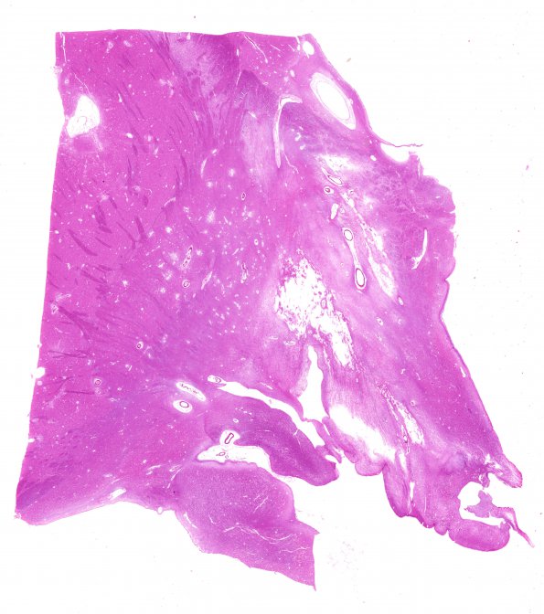 13B4 AD (Case 13) N2B H&E WM