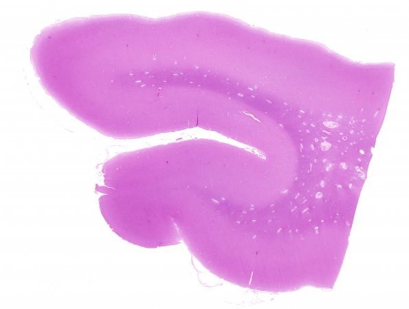 14A1 Arteriolosclerosis (Case 14) H&E whole mount