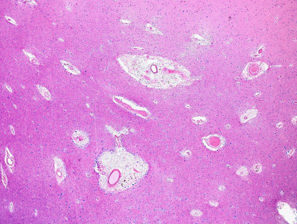 14A2 Arteriolosclerosis (Case 14) H&E 1