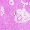 14A3 Arteriolosclerosis (Case 14) H&E 3