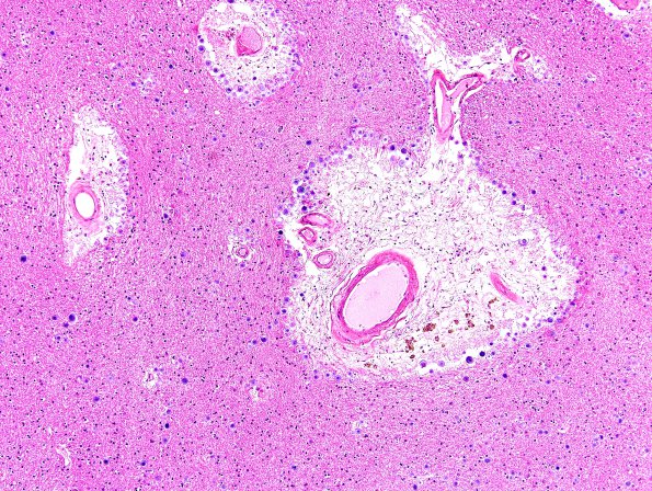 14A3 Arteriolosclerosis (Case 14) H&E 3