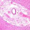 14A4 Arteriolosclerosis (Case 14) H&E 4