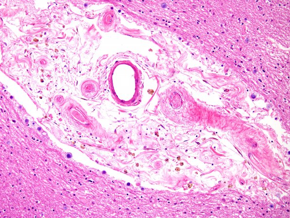 14A4 Arteriolosclerosis (Case 14) H&E 4