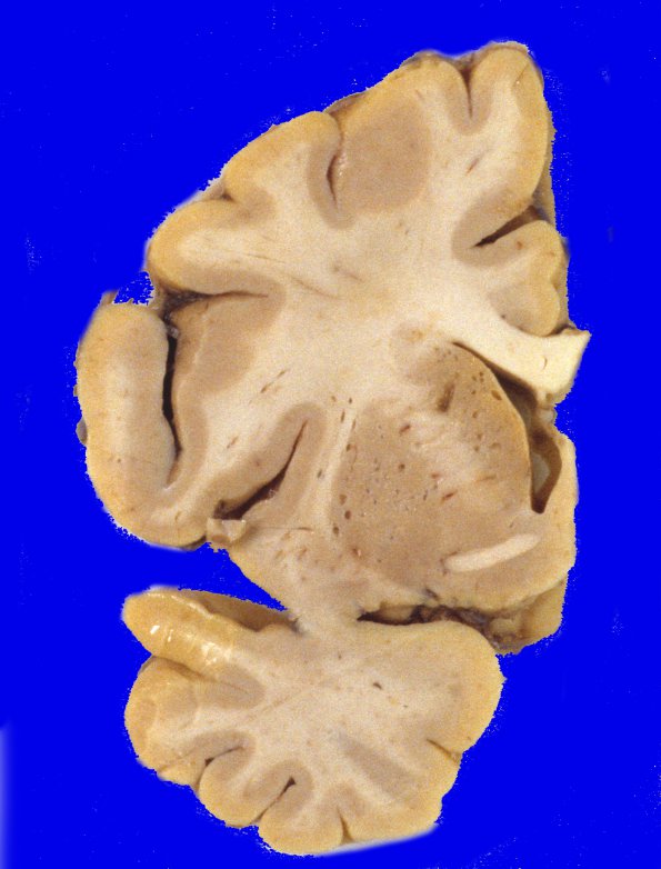 15A1 Hypertension, vasculopathy (Case 15) A