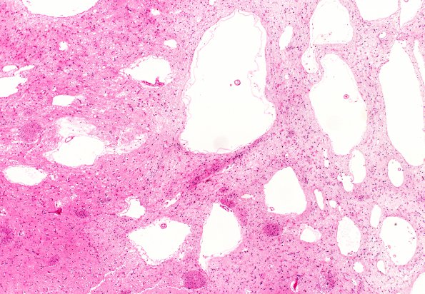 15B2 Hypertension, vasculopathy (Case 15) L6 4X