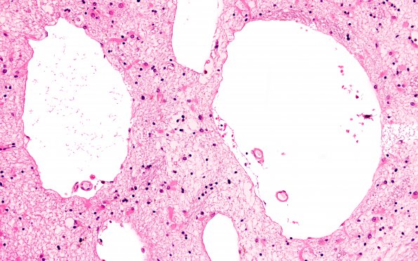 15B3 Hypertension, vasculopathy (Case 15) L6 20X