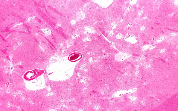 15B5 Hypertension, vasculopathy (Case 15) L29 2X