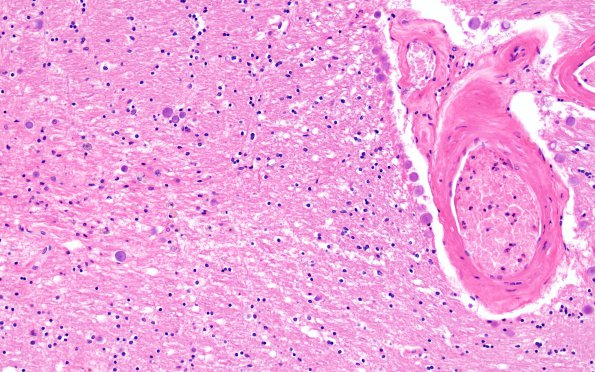 16A3 Hypertension (Case 16) N13 H&E 20X