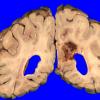 17A1 Infarct, subacute (Case 17) (hypertensive vessels) Gross _2