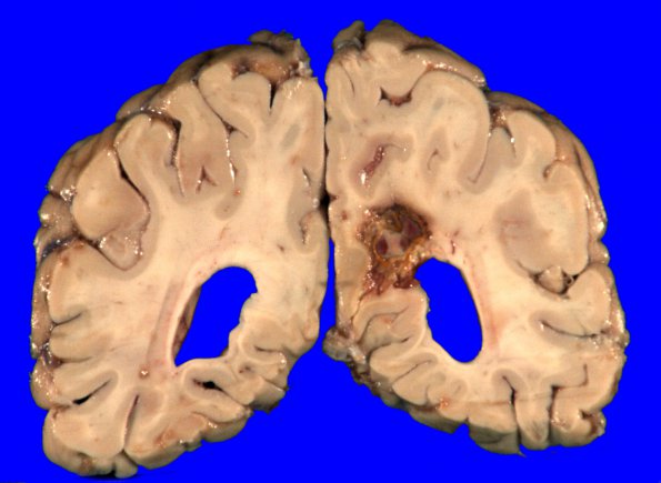 17A1 Infarct, subacute (Case 17) (hypertensive vessels) Gross _2