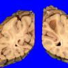 17A2 Infarct, subacute (Case 17) (hypertensive vessels) Gross _4