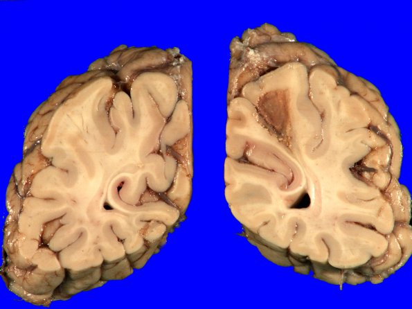 17A2 Infarct, subacute (Case 17) (hypertensive vessels) Gross _4