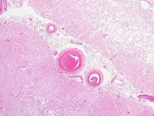 17A3 Infarct, subacute (Case 17) (hypertensive vessels) H&E 1