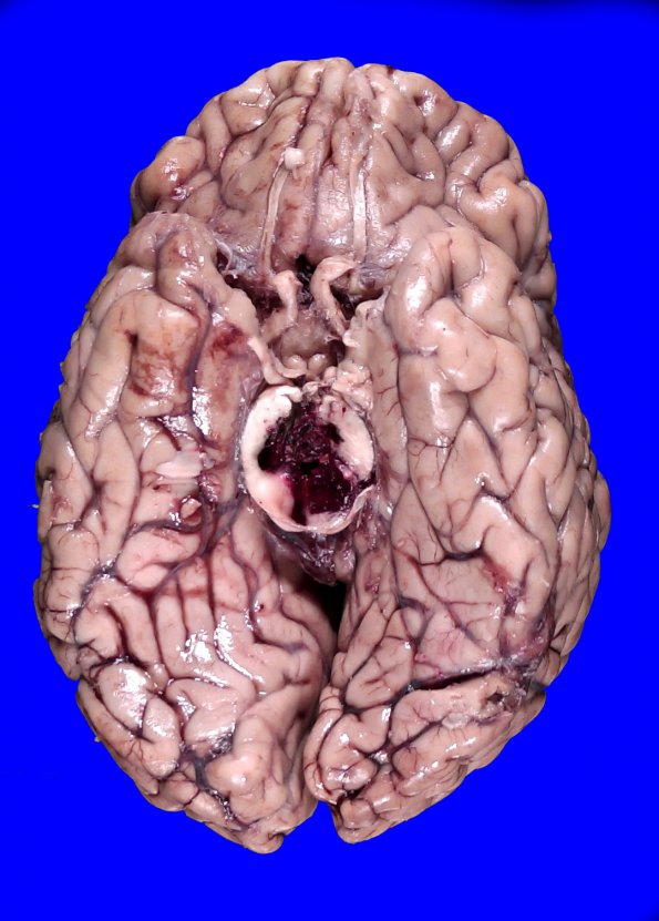 18A1 Hypertension, renal failure N2 (Case 18) A_1