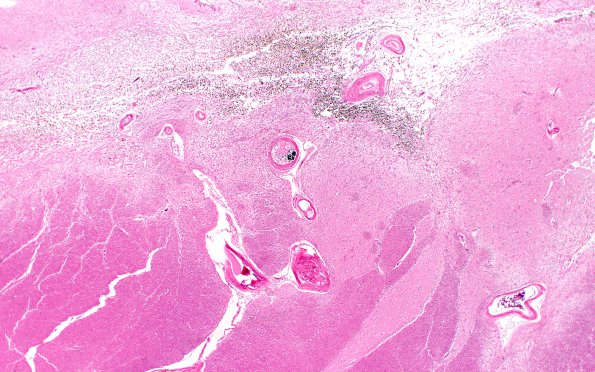 18B1 Hypertension, renal failure N2 (Case 18) H&E 2X