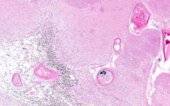 18B2 Hypertension, renal failure N2 (Case 18) H&E 4