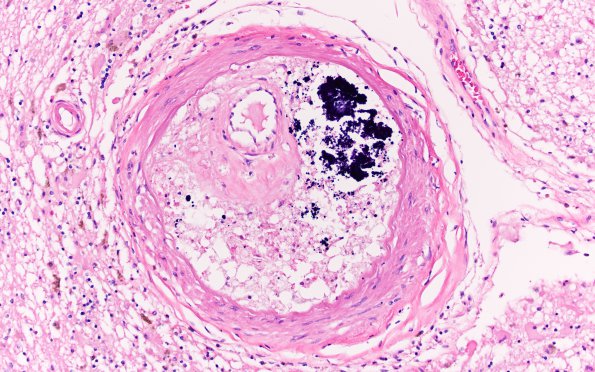 18B3 Hypertension, renal failure N2 (Case 18) H&E 1