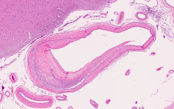 18B4 Hypertension, renal failure N2 (Case 18) H&E 6