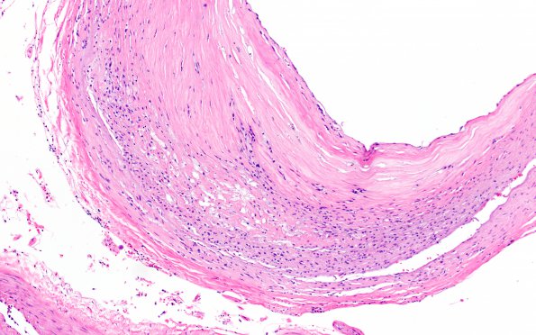 18B5 Hypertension, renal failure N2 (Case 18) H&E 5