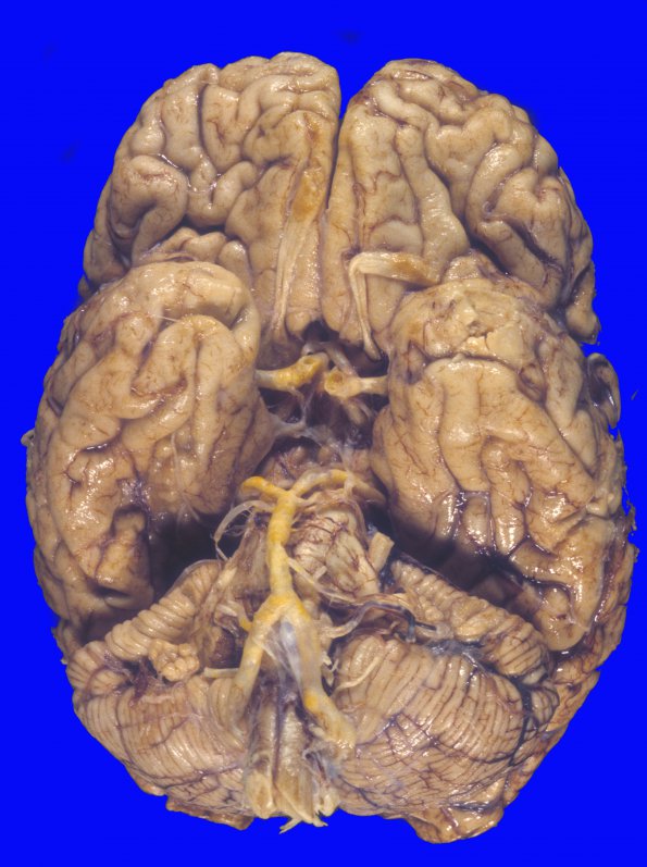 19A1 Infarcts, atherosclerosis (Case 19) 2