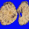 19A2 Infarcts, atherosclerotic (Case 19) 1