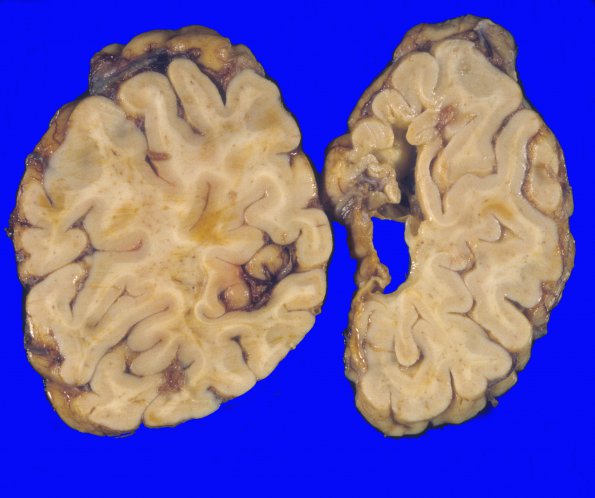 19A2 Infarcts, atherosclerotic (Case 19) 1