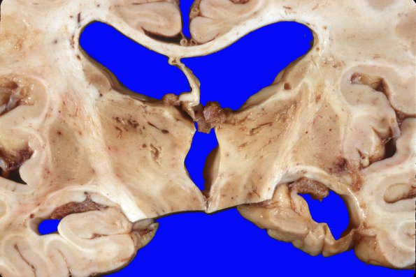 19A3 Infarcts, DM & HT (Case 19) gross 5