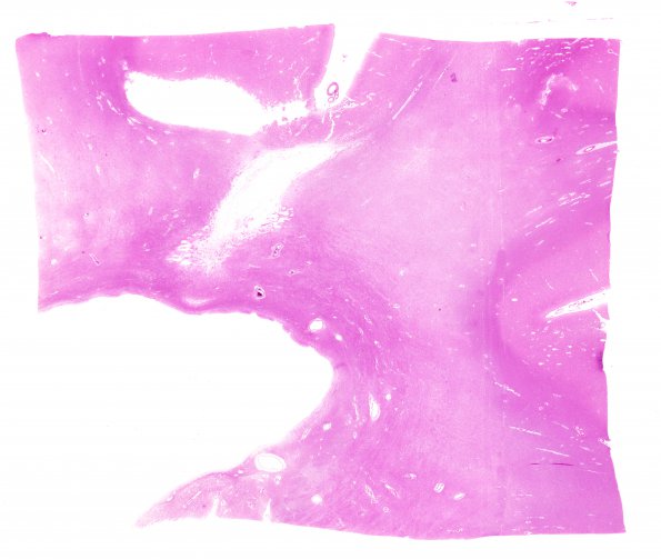 19B1 Atherosclerosis, DM & HT (Case 19) N14 H&E WM