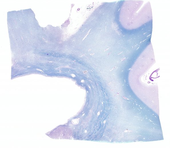 19B2 Atherosclerosis, DM & HT (Case 19) N14 LFB-PAS WM
