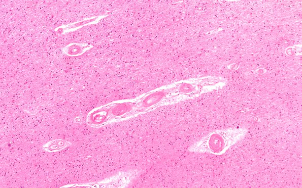 19B3 Atherosclerosis, DM & HT (Case 19) N1 H&E 10X