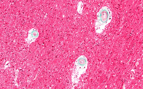 19B4 Atherosclerosis, DM & HT (Case 19) N1 Trichrome 20X