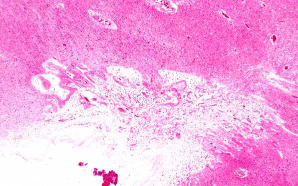 19B5 Atherosclerosis, DM & HT (Case 19) N14 4X