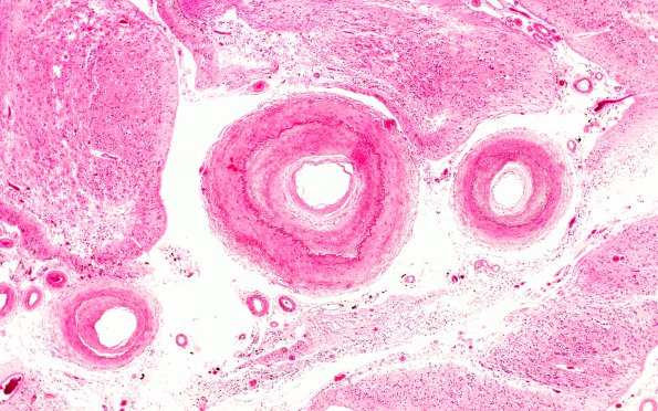 19C2 Atherosclerosis, DM & HT (Case 19) N5 H&E 4X