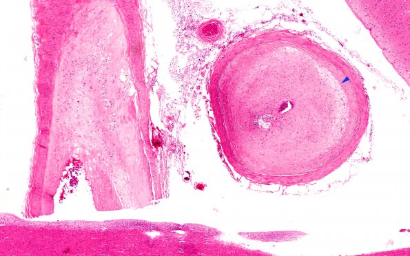 19D2 Atherosclerosis, DM & HT (Case 19) N11 4X copy