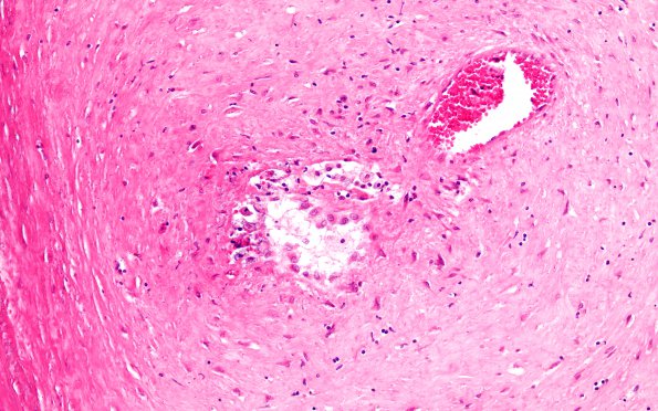 19D3 Atherosclerosis, DM & HT (Case 19) N11 20X