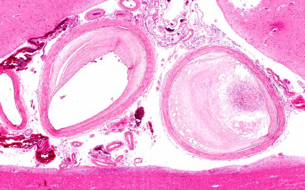 19E1 Atherosclerosis, DM & HT (Case 19) N13 4X