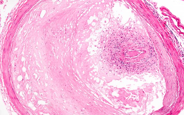 19E2 Atherosclerosis, DM & HT (Case 19) N13 10X