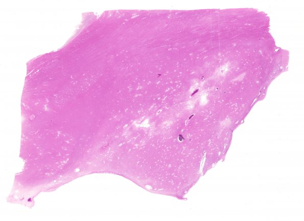 19F1 Atherosclerosis, DM & HT (Case 19) N4 H&E WM