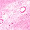 19F3 Atherosclerosis, DM & HT (Case 19) N4 H&E 10X