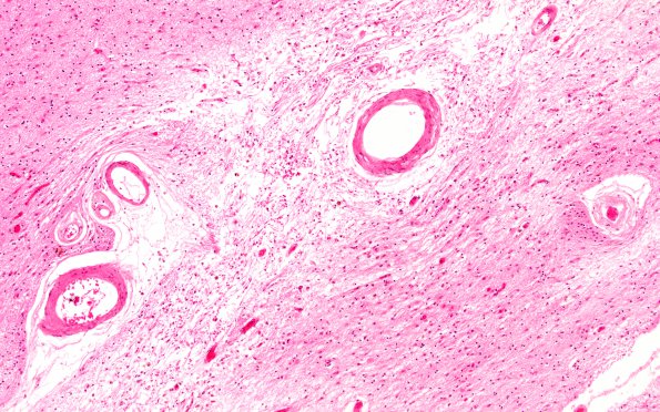 19F3 Atherosclerosis, DM & HT (Case 19) N4 H&E 10X