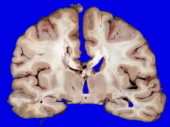 1A1 Infarct, remote (Case 1) Gross_3