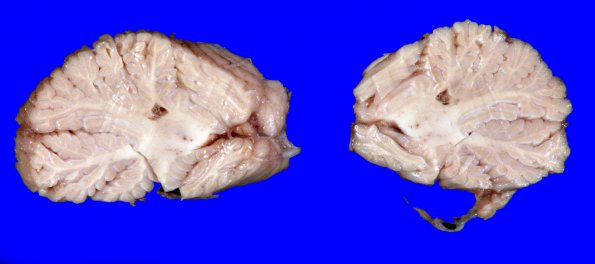 1A2 Infarct, remote (Case 1) gross1_5