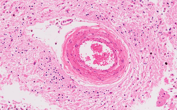 1B4 Small vessel Dz (Case 1) N2 H&E 20X 1