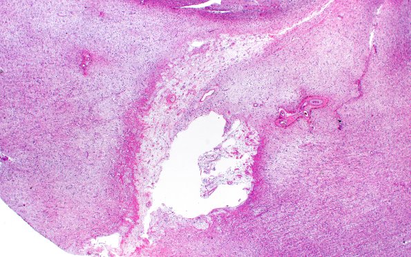20A1 Arteriolosclerosis (Case 20) N1 H&E 2X
