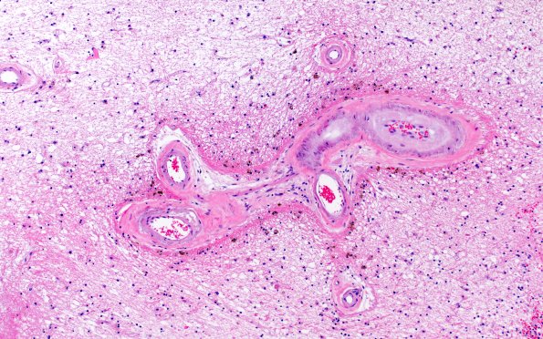 20A2 Arteriolosclerosis (Case 20) N1 H&E 1