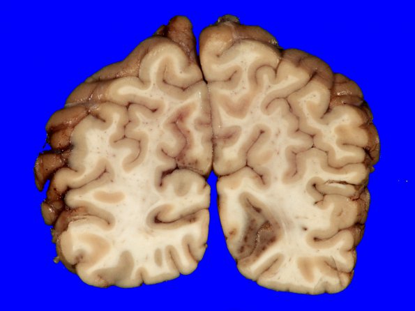 2A1 Hemorrhage, striatal w intraventricular, watershed, IV ventricle (A12-100) Gross 19