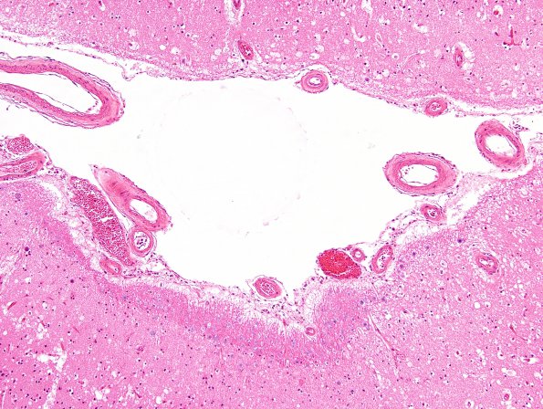 2B1 Arteriolosclerosis, hypertension (Case 2) H&E 1 (2)