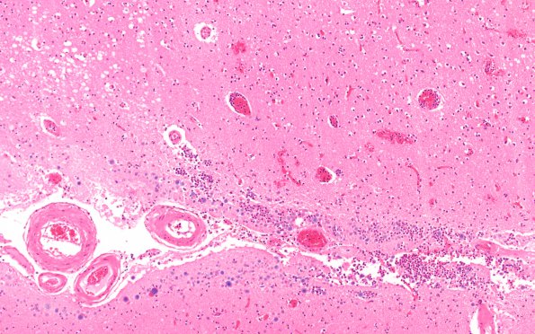 2B2 Arteriolosclerosis, hypertension (Case 2) N18 H&E 10X