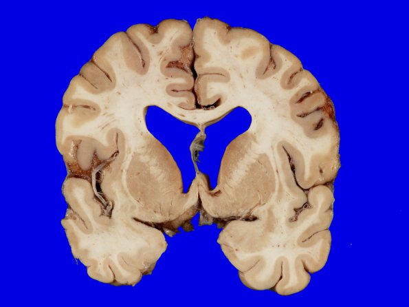 3A1 Arteriolosclerosis (Case 3) Gross_1